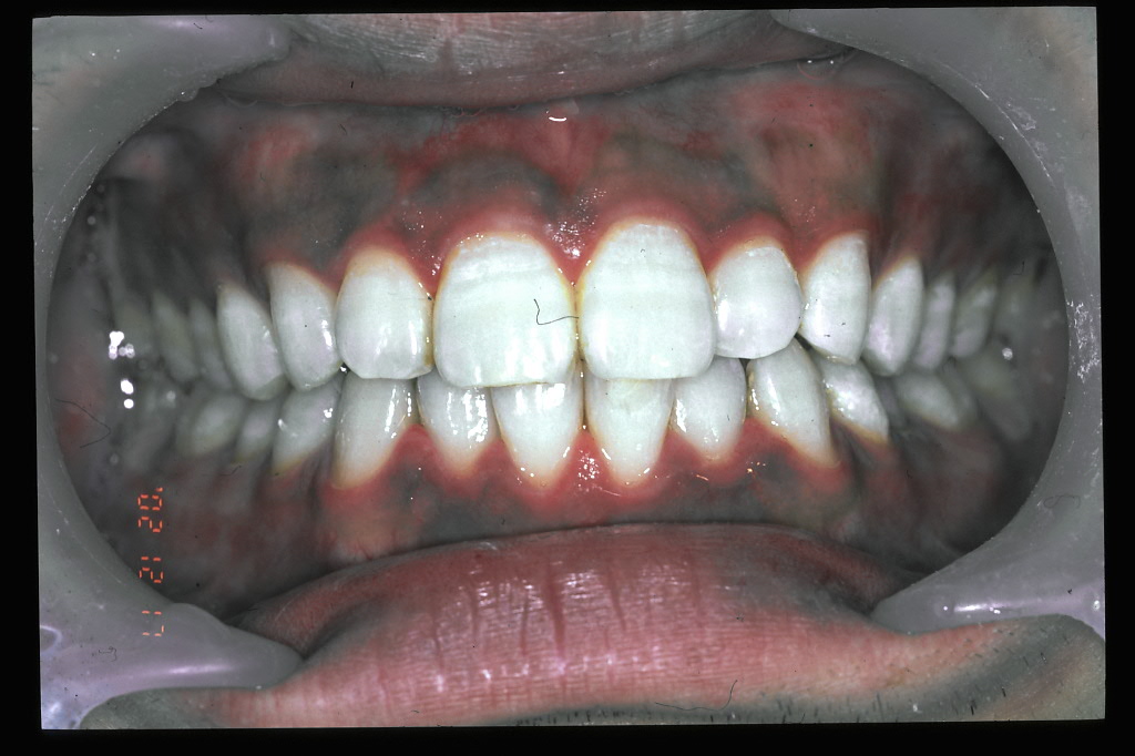 歯のホワイトニング・クリーニング